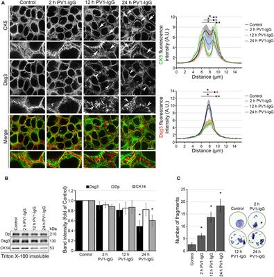 Keratin Retraction and Desmoglein3 Internalization Independently Contribute to Autoantibody-Induced Cell Dissociation in Pemphigus Vulgaris